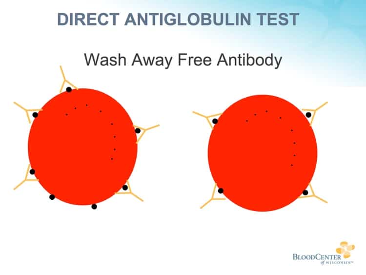 DAT procedure 3 - Washing removes interfering free antibody (compare to slide 2)