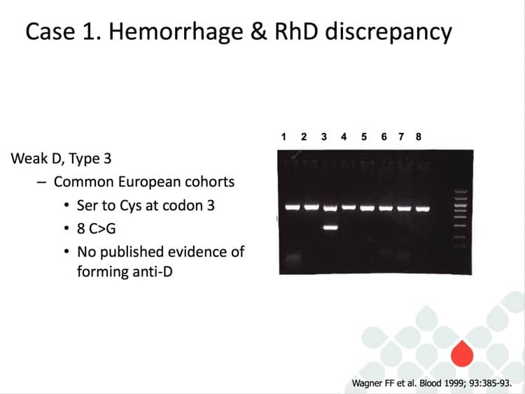 Delaney Slide 3 - Genotyping for this patient (Weak D type 3)
