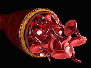 Sickled RBCs in a vein